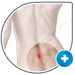 Cirurgia de Cisto Pilonidal | Gastrus Clinic em Taguatinga